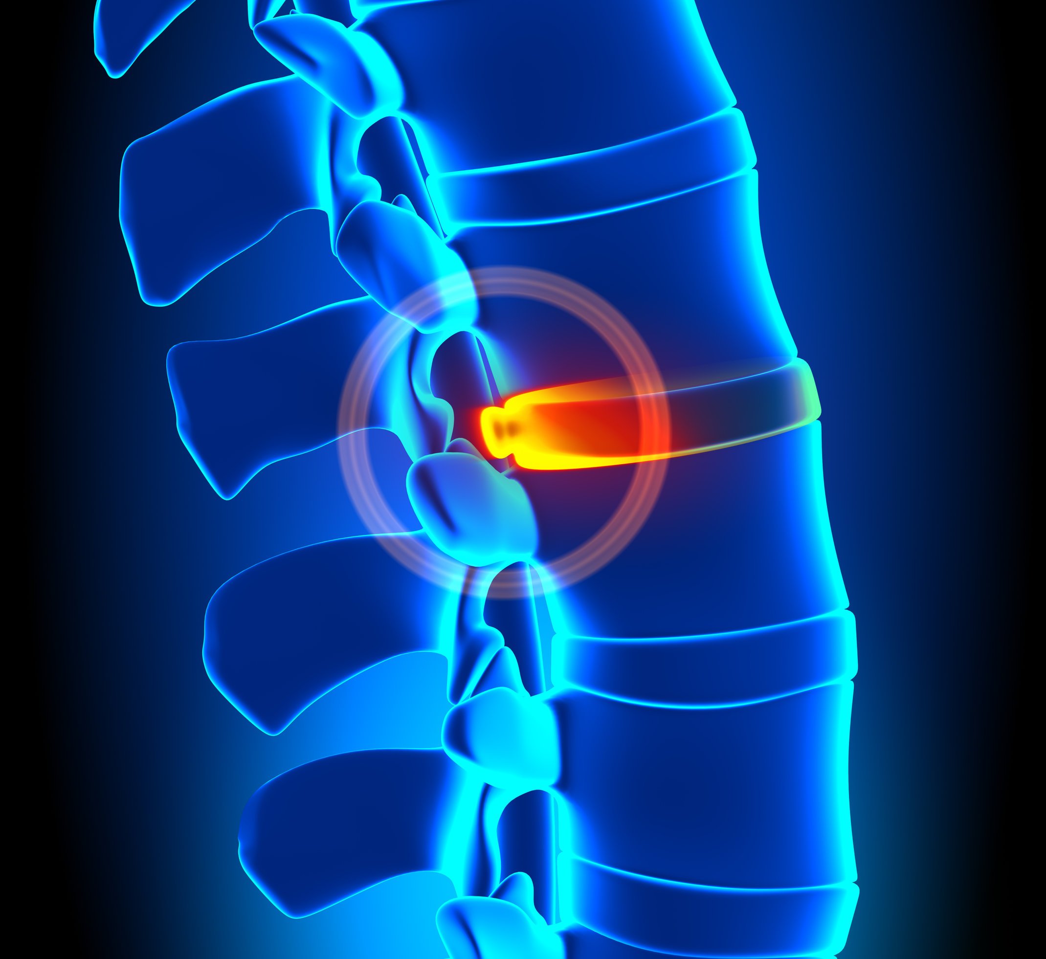 stem cell treatment for bulging disc