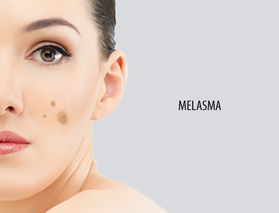 What is the best treatment for melasma