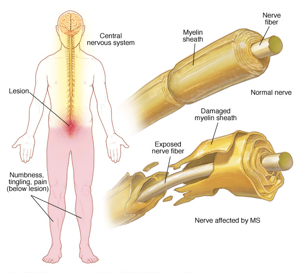 multiple-sclerosis-bioxelerator-pic1.png